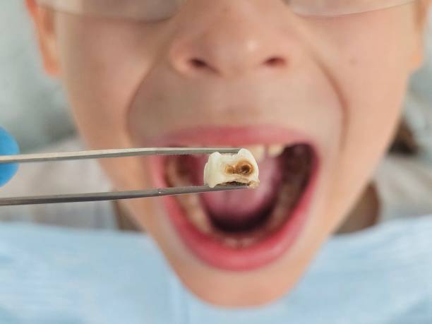 Best Broken or Cracked Tooth Emergency Dentist in South Amboy, NJ